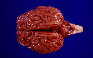 Onderontwikkelde kleinbrein