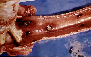 Knopvelletsel in die lugpyp.