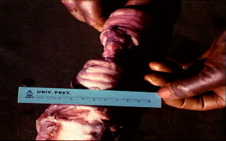 Vernouing in die lugpyp na genesing van knopvelletsels.