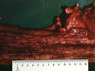 Letsels in die slukderm