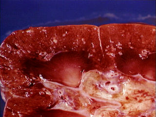 Swelling van die nier